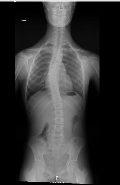 Raio-X da escoliose idiopática do adolescente sem colete — curva vertebral lateral visível